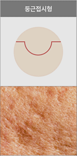 잠실여드름흉터 깊어도 치료 가능할까? 관련 이미지 6