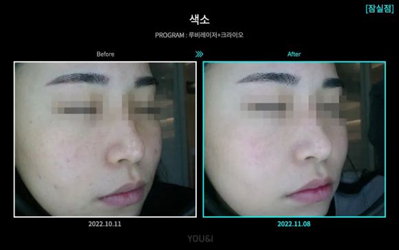Jamsil Ruby Laser: Which Pigments Is It Effective For? image 4