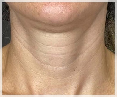 How much can Radiesse help with neck wrinkles? image 1