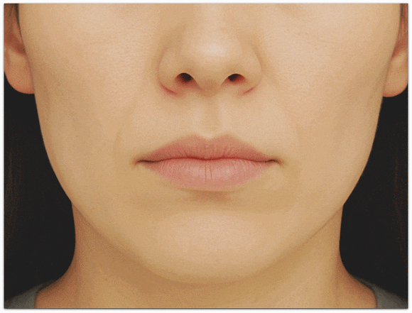Songpa Lifting: Is There a Factor That Determines the Right Lifting Treatment for Me? image 9