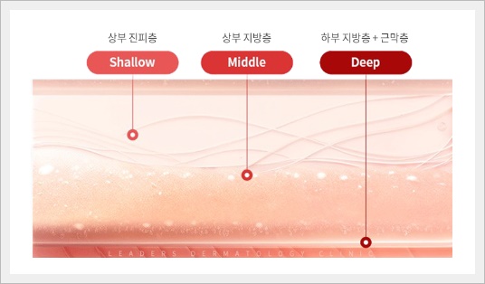 잠실 세르프, 써마지랑 어떻게 다른 걸까? 관련 이미지 4