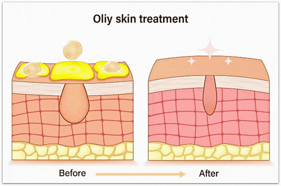 How Can You Tell Whether Acne Dermatology Treatment in Jamsil Is Going Well? image 7