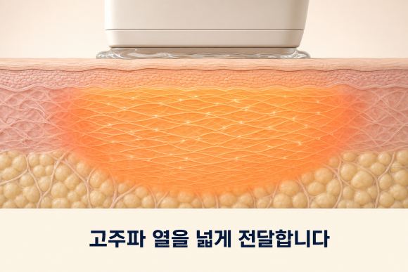 송파 써마지리프팅, 울쎄라와 무엇이 다를까요? 관련 이미지 2