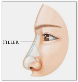 잠실역필러 잘하는 곳? 뭘 보고 결정해야 할까? 관련 이미지 5