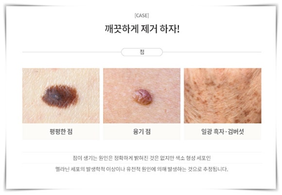 Jamsil Mole Removal: You Shouldn’t Remove Just Any Mole image 3