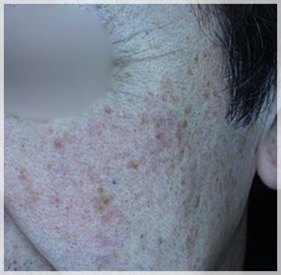 What You Need to Know About Melasma Removal in Jamsil image 1