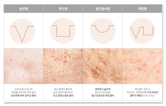 잠실여드름흉터, 패인 자국과 넓어진 모공으로 고민이라면 관련 이미지 5
