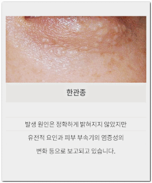How to Tell if It’s Milia in Jamsil? What If It Spreads or Gets Bigger? image 3