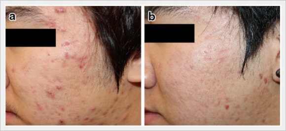 Jamsil Acne Scars: Can Depressed Marks Really Become Less Noticeable? image 8