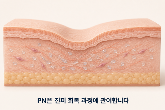 잠실 리쥬란 S, 패인 여드름 흉터에 효과 볼 수 있을까? 관련 이미지 1