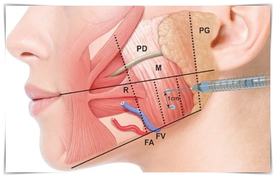 What You Must Know Before Getting Square Jaw Botox in Jamsil image 5