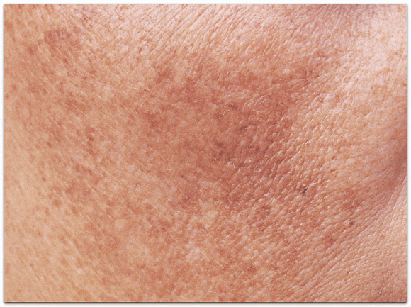 What Was the Reason Lase Toning in Jamsil Couldn’t Produce Results for Deep-Seated Melasma? image 5