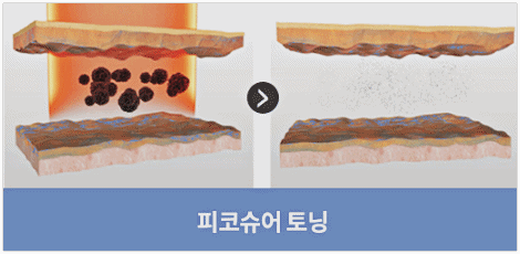 Jamsil Picosure Effects and Who It’s Recommended For (Including Tips to Lower the Cost) image 7