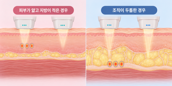 송파구리프팅, 울쎄라리프라임 샷 선택 기준과 효과는? 관련 이미지 5