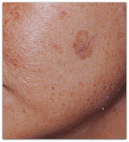 How much can Jamsil Pico Toning help remove melasma, age spots, freckles, and lentigines? image 4