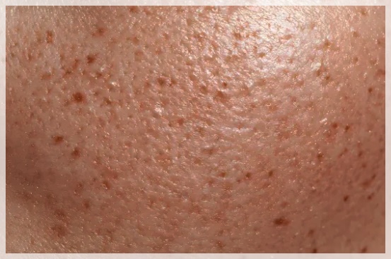 잠실피코토닝 기미 잡티 치료에 정답일까? 관련 이미지 3