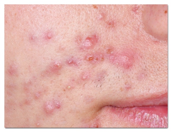 Recommended Jamsil Acne Dermatology Clinic (Department: Dermatology) image 1