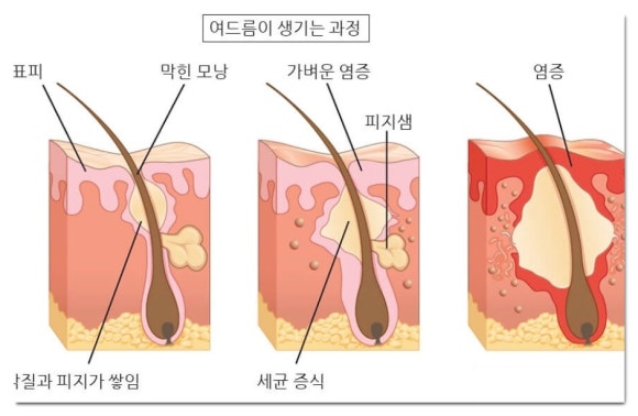 Recommended Jamsil Acne Dermatology Clinic (Department: Dermatology) image 2