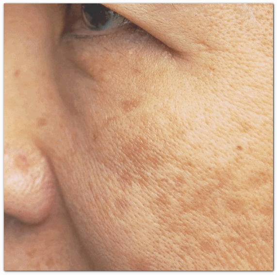 What Was the Reason Lase Toning in Jamsil Couldn’t Produce Results for Deep-Seated Melasma? image 1
