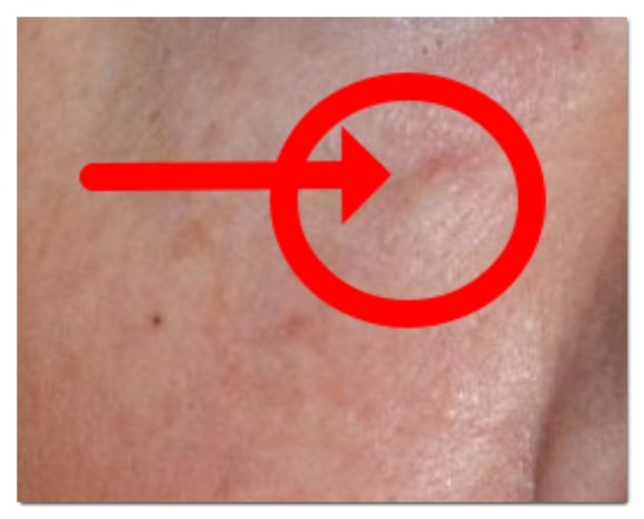 Songpa Dermatology Clinic Juvelook Review: What to Check If You’re Considering It for Enlarged Pores (Department: Dermatology) image 4