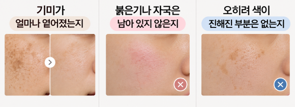 잠실레이저토닝, 몇 번 받아야 할지 고민이라면? 관련 이미지 4