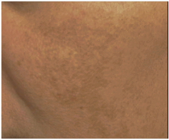 Jamsil PicoSure: If you’re worried about skin pigmentation issues like melasma and dark spots image 2