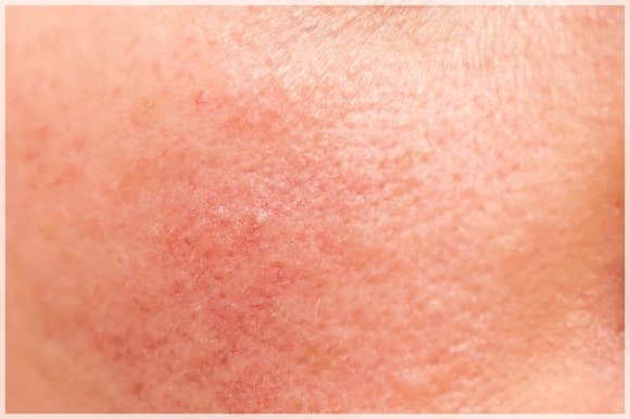 What Are the Benefits of Getting Larapil and Laser Toning Together? image 4