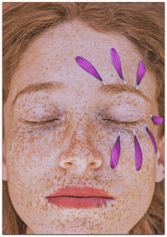 Jamsil PicoSure: If you’re worried about skin pigmentation issues like melasma and dark spots image 3