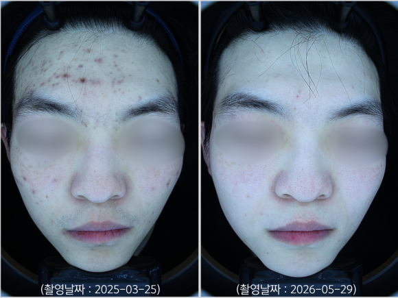 Jamsil Acne Dermatology Clinic: A Case of Treating Acne Pigmentation Scars image 5