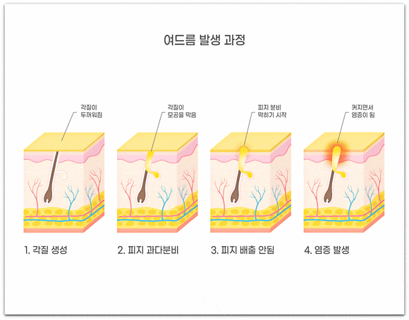 송파 피부과 트러블, 곪은 여드름이 아니면 치료 안 해도 된다? 관련 이미지 3
