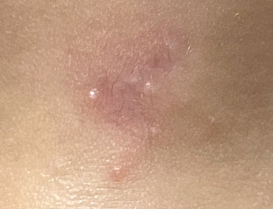 Milia and Dissolved Thread Exposure image 1