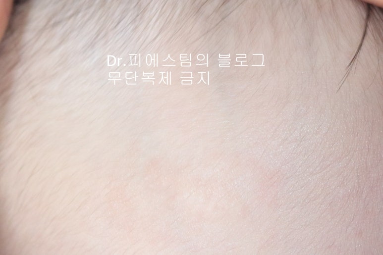응급실에서 얼굴 상처 일반 봉합 후, 성형외과 흉터 레이저 치료 사례 - 뺨 & 이마 (2) 입니다 관련 이미지 11