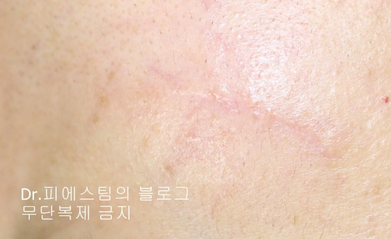 얼굴 찢어진 상처 봉합 성형외과 치료 사례 - 들린 상처: 피판에 관하여 2편입니다 입니다 관련 이미지 7