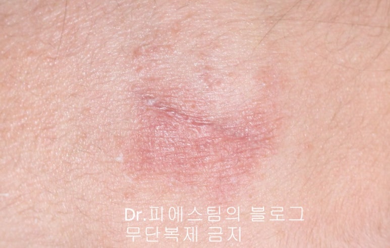 응급실에서 얼굴 상처 일반 봉합 후, 성형외과 흉터 레이저 치료 사례 - 뺨 & 이마 (2) 입니다 관련 이미지 7