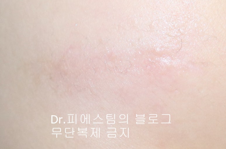 응급실에서 얼굴 상처 일반 봉합 후, 성형외과 레이저 치료 사례 - 뺨 & 이마 (1) 입니다 관련 이미지 6