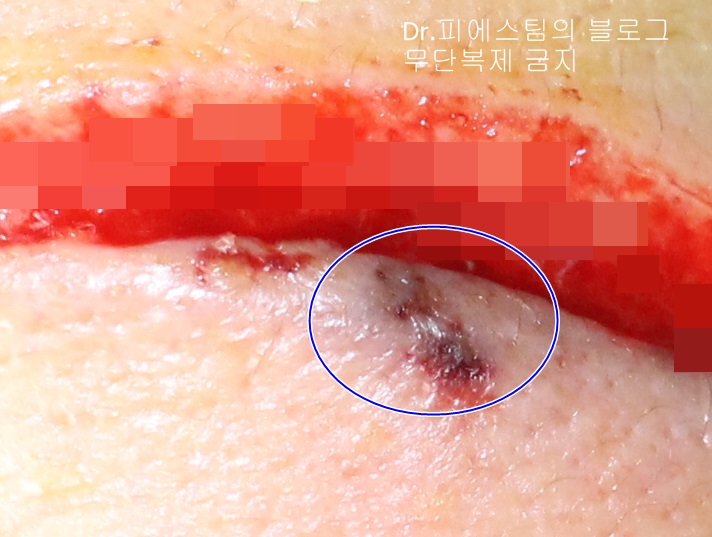 얼굴 찢어진 상처 봉합 성형외과 치료 사례 - 들린 상처: 피판에 관하여 2편입니다 입니다 관련 이미지 3