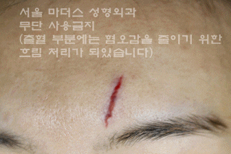 얼굴 상처 봉합 성형외과 - 이마 상처 : 미세 봉합 & 흉터 레이저 관련 이미지 12