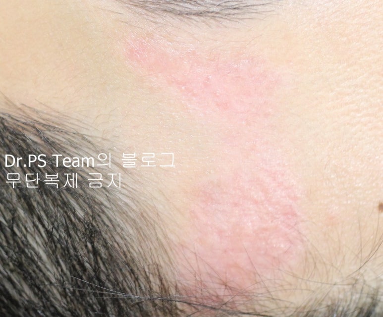 얼굴 찢어진 상처 봉합 & 얼굴 흉터 레이저 성형외과 치료 사례 - 큰 피부 결손 편입니다. 관련 이미지 8