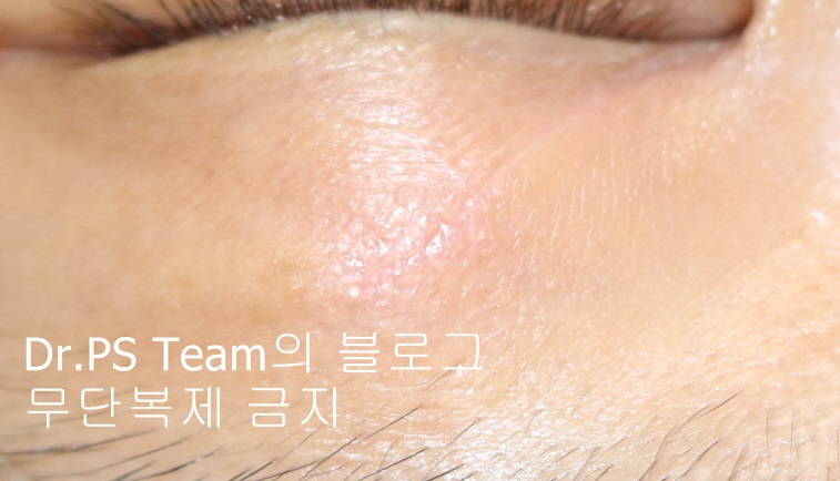 얼굴 찢어진 상처 미세 봉합 & 흉터 레이저 성형외과 치료 사례 - 상안검 편입니다. 관련 이미지 5