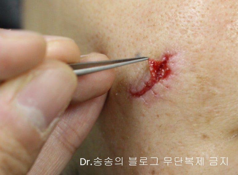 얼굴 찢어진 상처 봉합 성형외과 치료 사례 - 들린 상처 (일명 트랩도어) 편입니다 관련 이미지 7