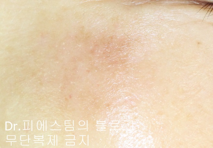 얼굴 상처 봉합 외 표재성 손상, 찰과상의 성형외과 색소침착 치료 사례 - 광대 편입니다 관련 이미지 13