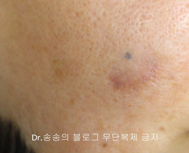 얼굴 찢어진 상처 봉합 성형외과 치료 사례 - 들린 상처 (일명 트랩도어) 편입니다 관련 이미지 10
