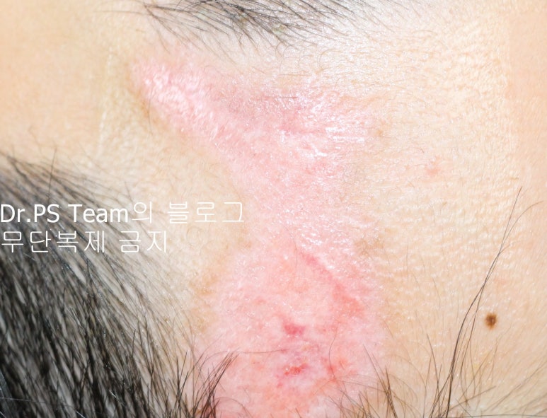 얼굴 찢어진 상처 봉합 & 얼굴 흉터 레이저 성형외과 치료 사례 - 큰 피부 결손 편입니다. 관련 이미지 4