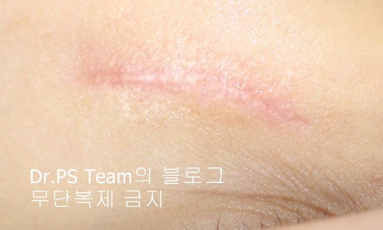 응급실에서 얼굴 상처 일반 봉합 후, 성형외과 흉터 레이저 치료 사례 - 하안검(아래눈꺼풀) 편 입니다 관련 이미지 4