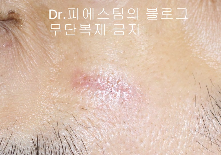 얼굴 찢어진 상처 봉합 성형외과 치료 사례 - 코와 피판에 관하여-1편입니다 관련 이미지 5