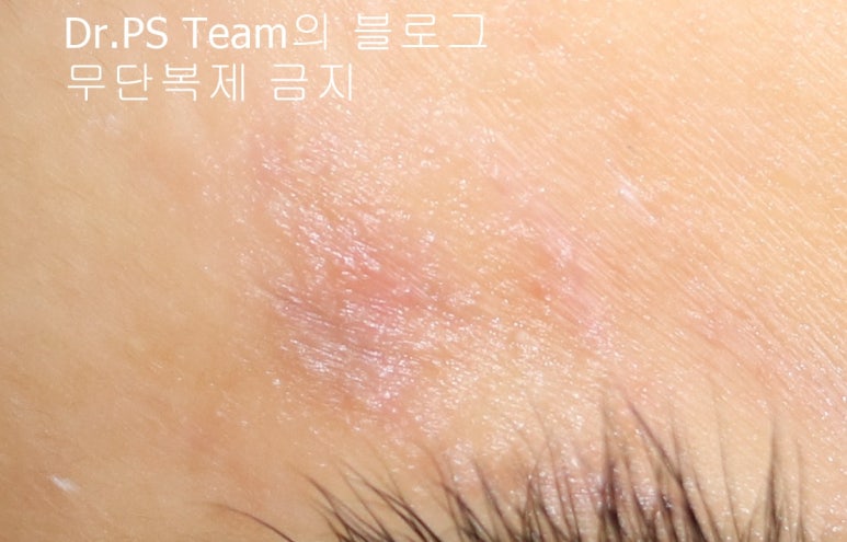 얼굴 찢어진 상처 봉합 & 얼굴 흉터 레이저 성형외과 치료 사례 - 늦어진 상처 봉합 (Delayed wound closure) II - 하안검 편입니다. 관련 이미지 5