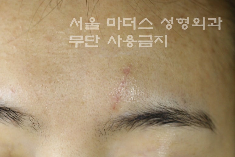 얼굴 상처 봉합 성형외과 - 이마 상처 : 미세 봉합 & 흉터 레이저 관련 이미지 4