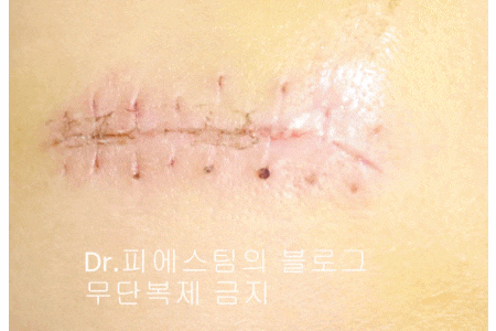 응급실에서 얼굴 상처 일반 봉합 후, 성형외과 레이저 치료 사례 - 뺨 & 이마 (1) 입니다 관련 이미지 8