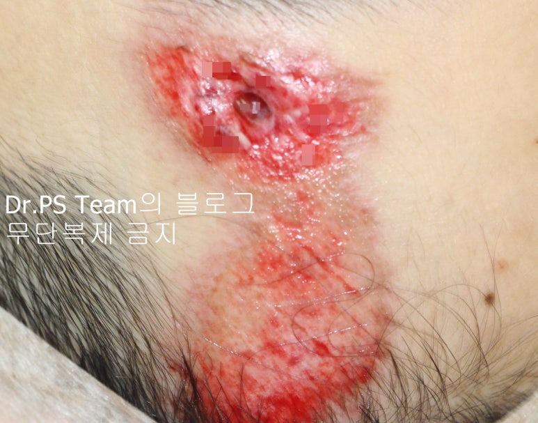 얼굴 찢어진 상처 봉합 & 얼굴 흉터 레이저 성형외과 치료 사례 - 큰 피부 결손 편입니다. 관련 이미지 2