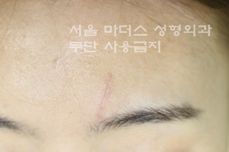 얼굴 상처 봉합 성형외과 - 이마 상처 : 미세 봉합 & 흉터 레이저 관련 이미지 3